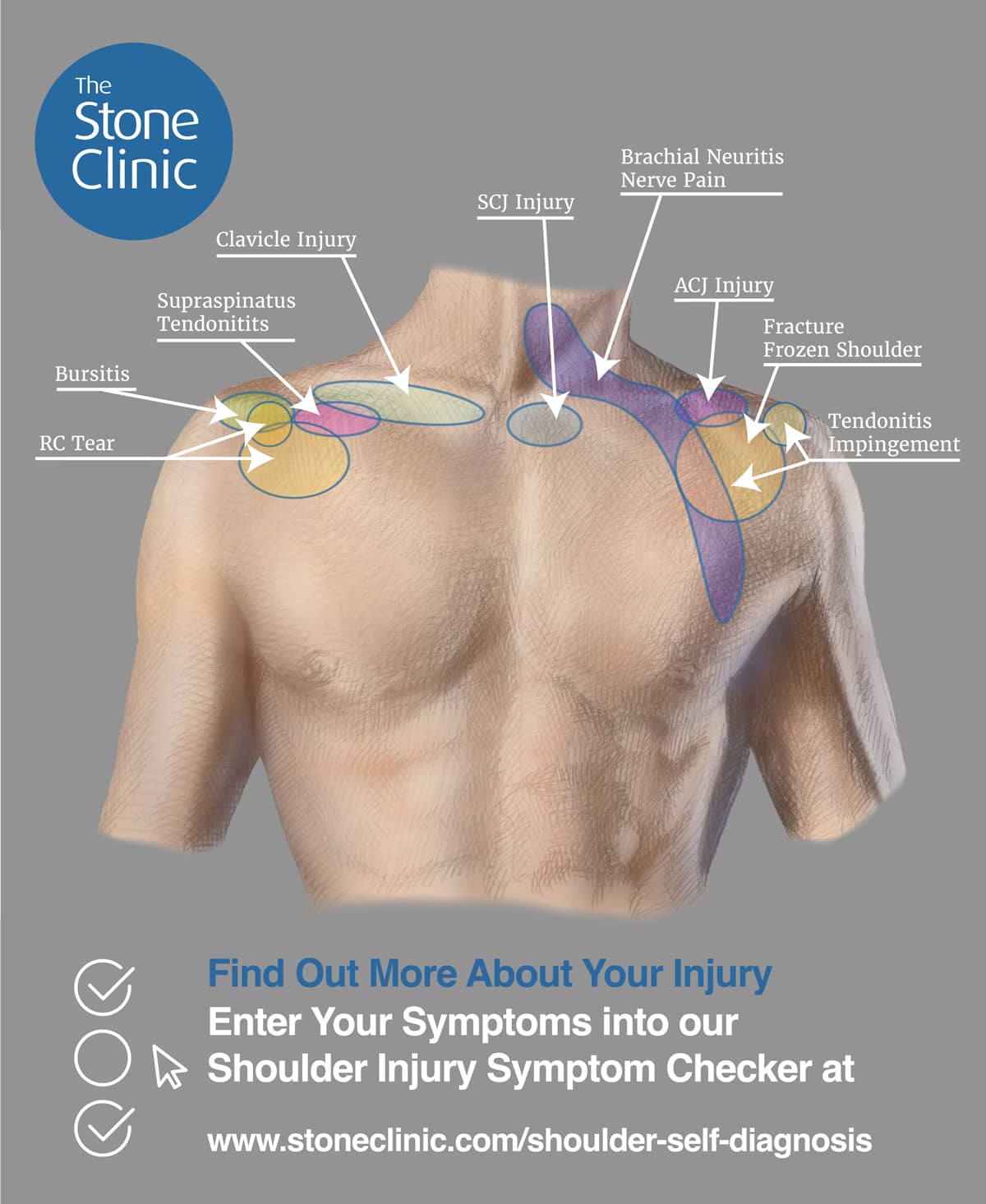 Torn rotator cuff clearance symptoms diagnosis